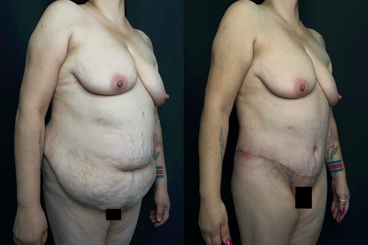 Liposuction Before & After Gallery - Patient 56112201 - Image 1