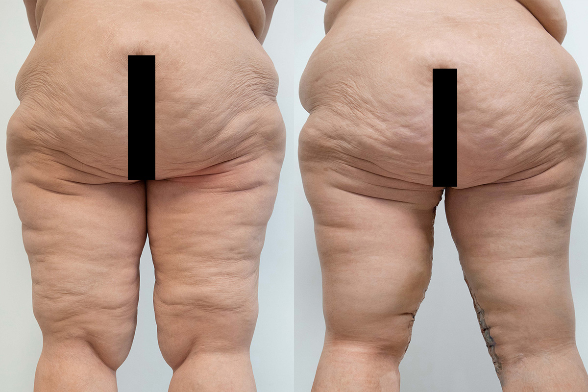 Body Lift Before & After Gallery - Patient 64084210 - Image 2