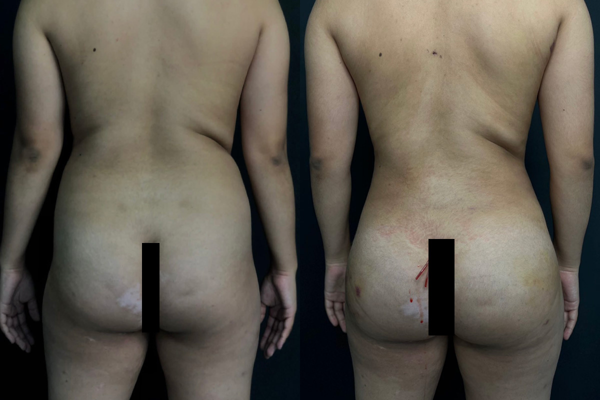 Liposuction Before & After Gallery - Patient 56112260 - Image 1