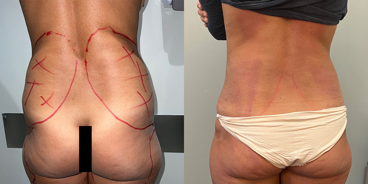 Liposuction Before & After Gallery - Patient 55793694 - Image 3